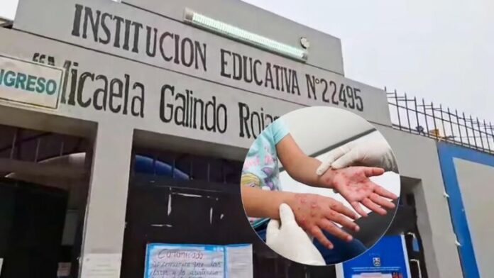 Primer caso Cocsaki